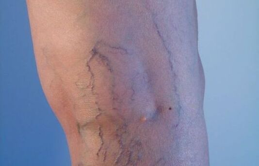 Κιρσοί στα πόδια στις γυναίκες