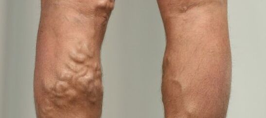 Κιρσοί στο πόδι