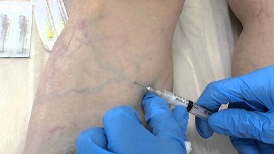 Σκληροθεραπεία για κιρσούς στα πόδια στις γυναίκες